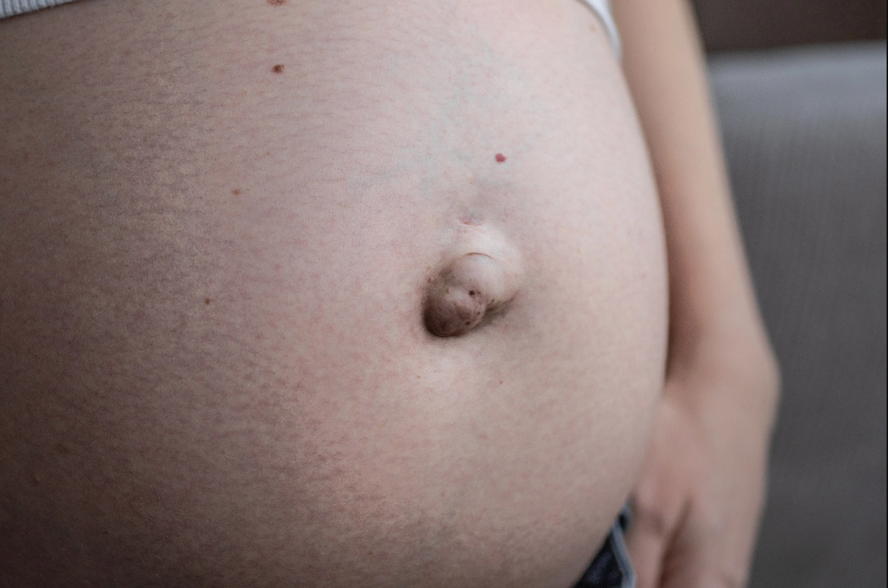 FamiBlog - Hernies ombilicales pendant la grossesse